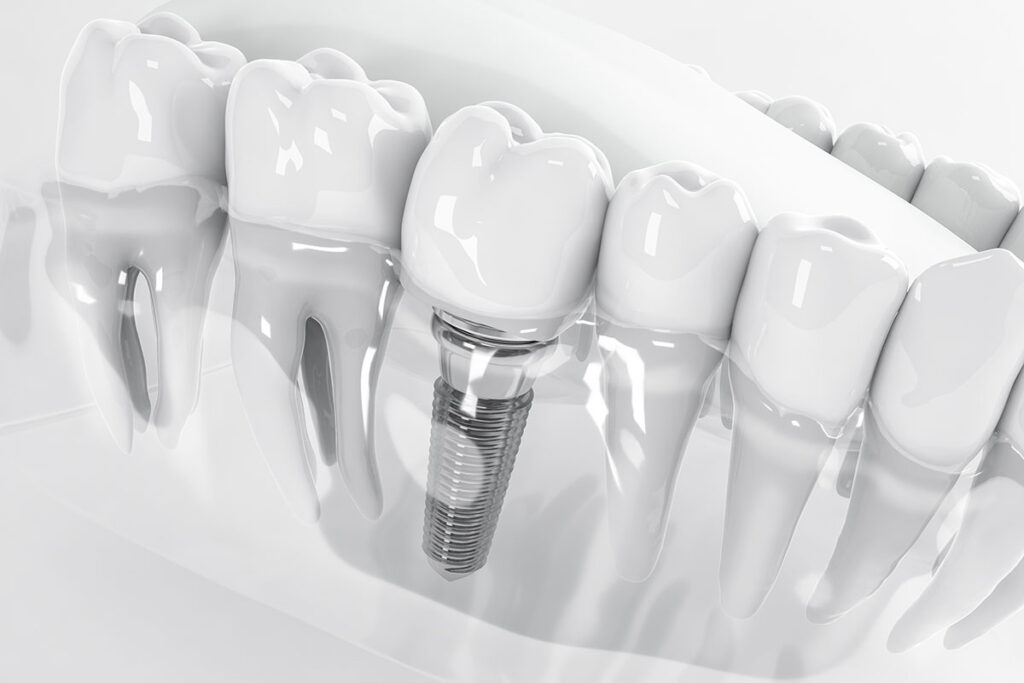 Die beste Lösung bei Zahnverlust: Zahnersatz auf Implantaten